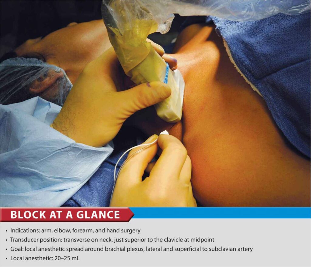 Importance of Handheld Ultrasound for Nerve Block in Anesthesiologists