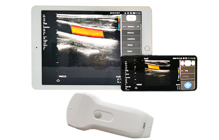 20 Vascular Applications of Handheld Wireless Color Doppler Ultrasound