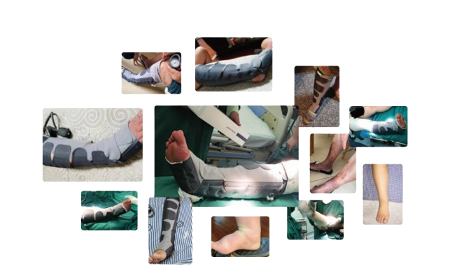 CuraWay Adjustable Limb Compression Device clinical Application