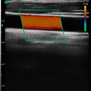 handheld wireless color doppler portable ultrasound for vascular