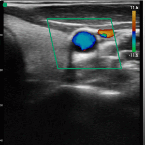 handheld wireless color doppler portable ultrasound for vascular