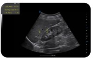 Digitat AI-Powered Color Doppler HRI QA Usg