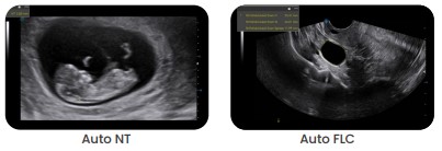 Digitat AI-Powered Color Doppler Usg