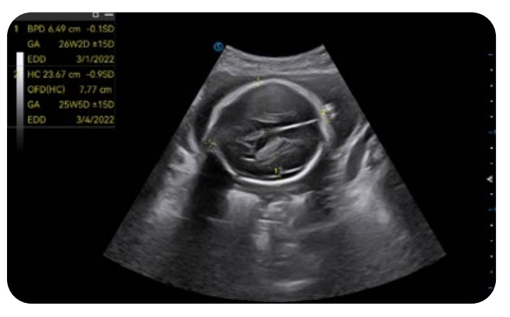 Best Portable Point of Care Ultrasound
